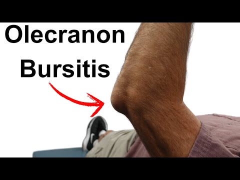 Olecranon Bursitis