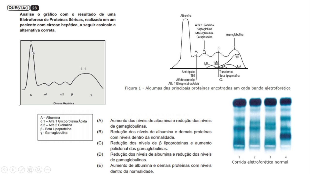 Eletroforese de proteínas - Interpretação clínica e  Exercício comentado