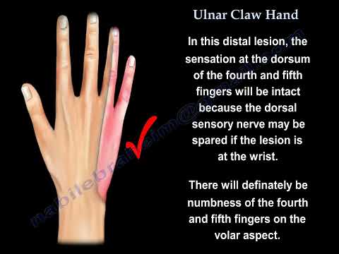 A Detailed Look at Claw Hand: Causes and Ulnar Nerve Injuries