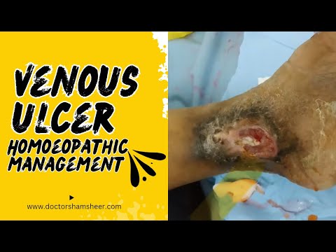 Took 5 month to cure Venous leg ulcers