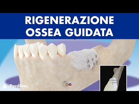 Rigenerazione ossea guidata ©