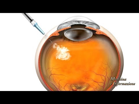 Laser epilation della faccia di uomini Unguenti e gel da borse sotto risposte di occhi