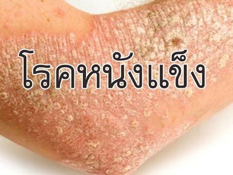 โรคสะเก็ดเงิน betasalin โลชั่น ความคิดเห็น akrustal สำหรับโรคผิวหนัง