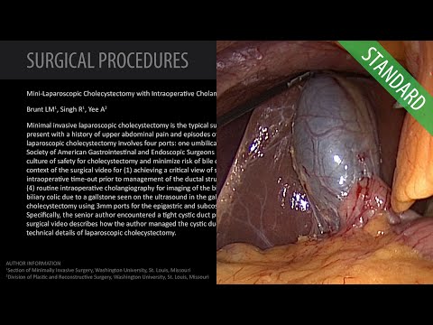 Laparoscopic Cholecystectomy for Symptomatic Cholelithiasis - Standard (Feat. Dr. Brunt)