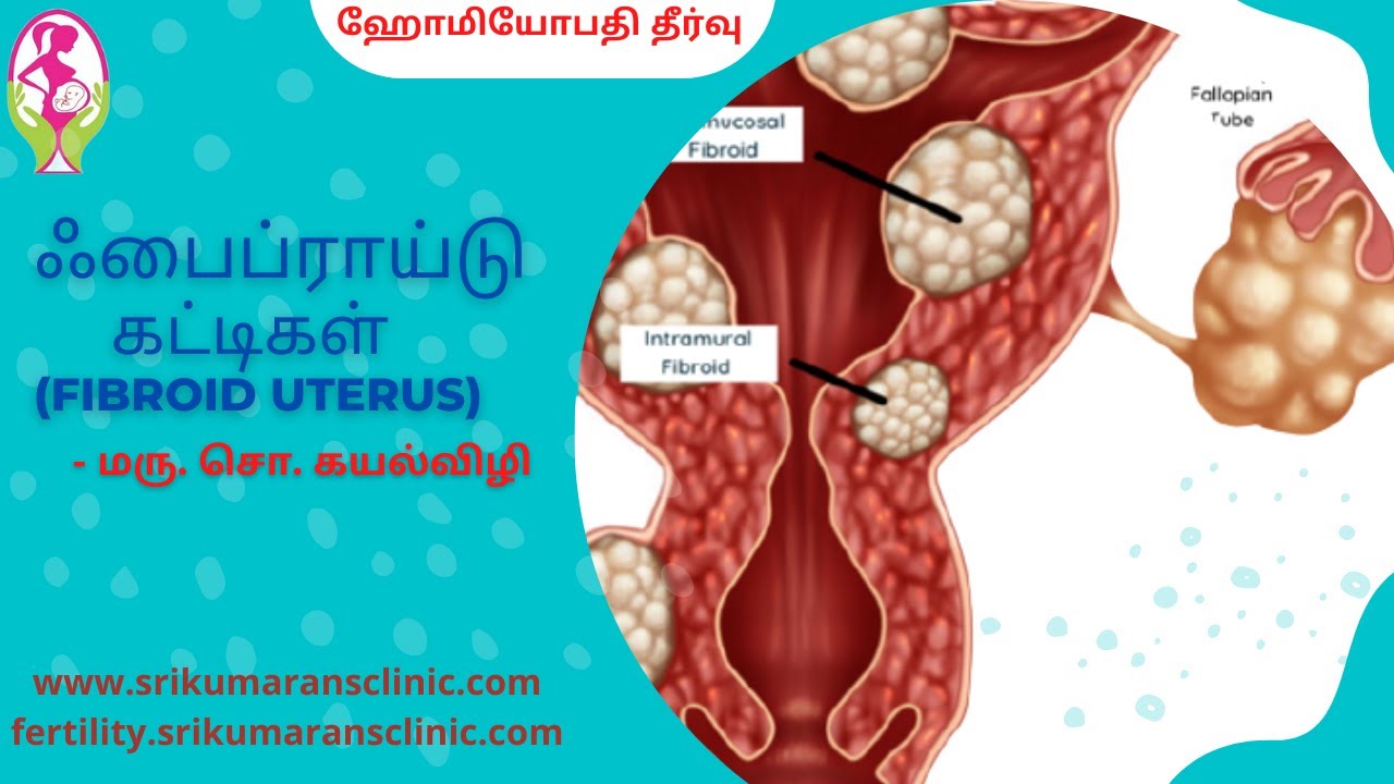 Uterine Fibroids & HomoeopathyTamil Version - Dr.C. Cayalvizhi