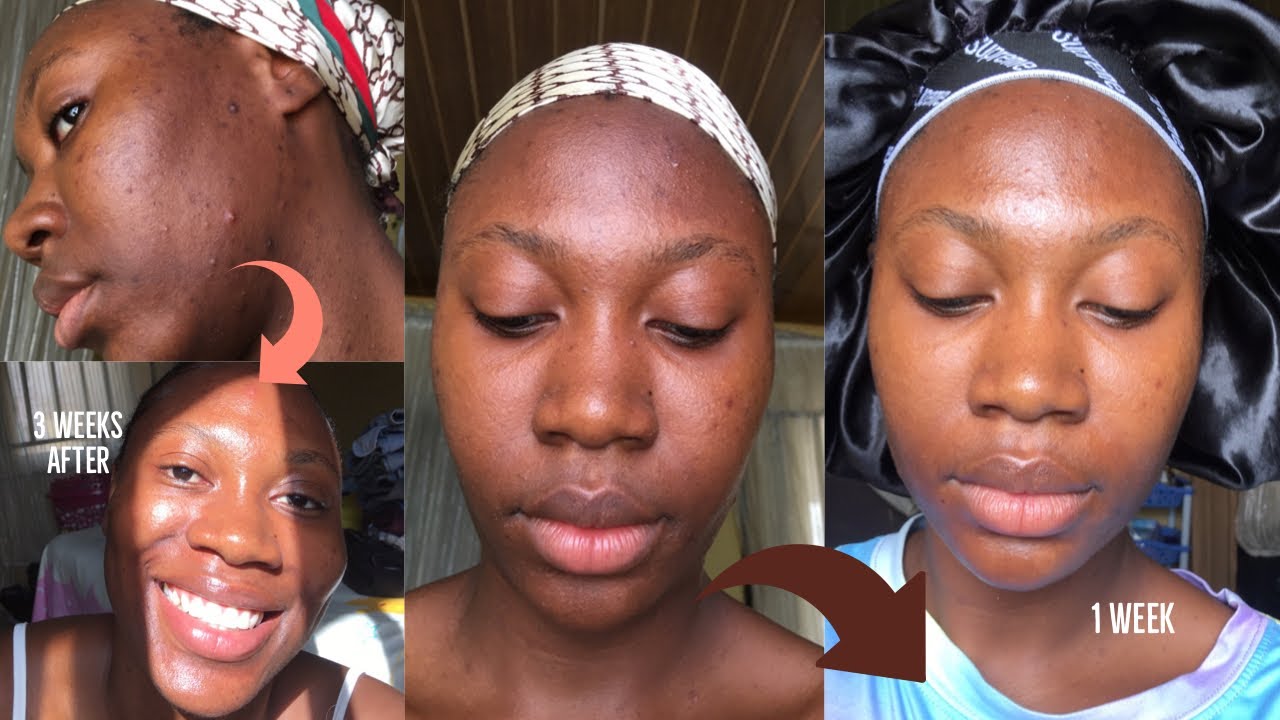 Kojie San kojic acid skin lightening Soap | 3 weeks honest Review with before and after