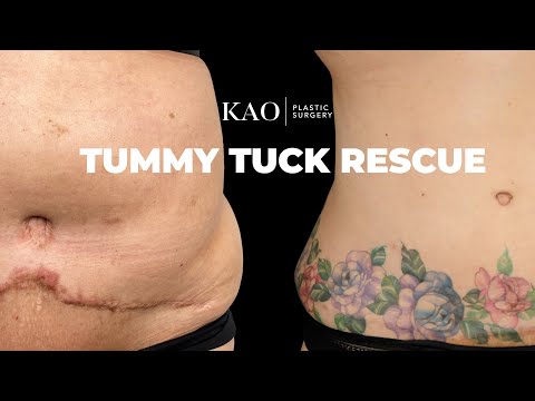 agenții de pierdere în greutate tummy tuck)