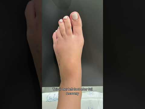 FOOT DOCTOR LENGTHENS TOE!