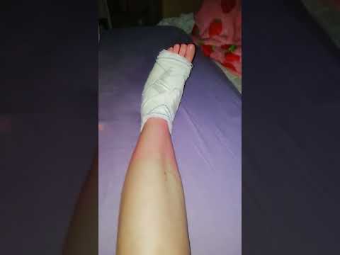 voet operatie 1e dag herstel van de 2e operatie