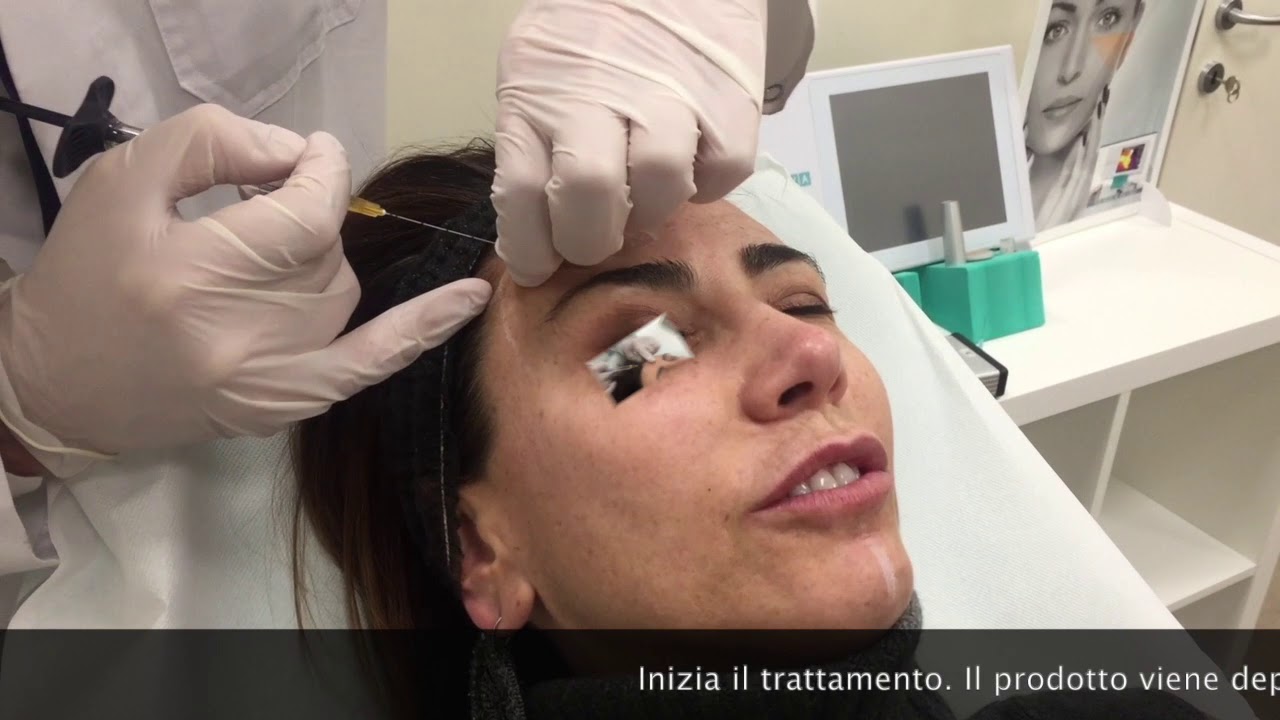 www.faceboost.org: Il rimodellamento della fronte  con filler a base di acido ialuronico