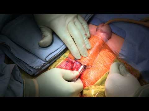 Retractor-less Approach to Implantation of Penile Prosthesis