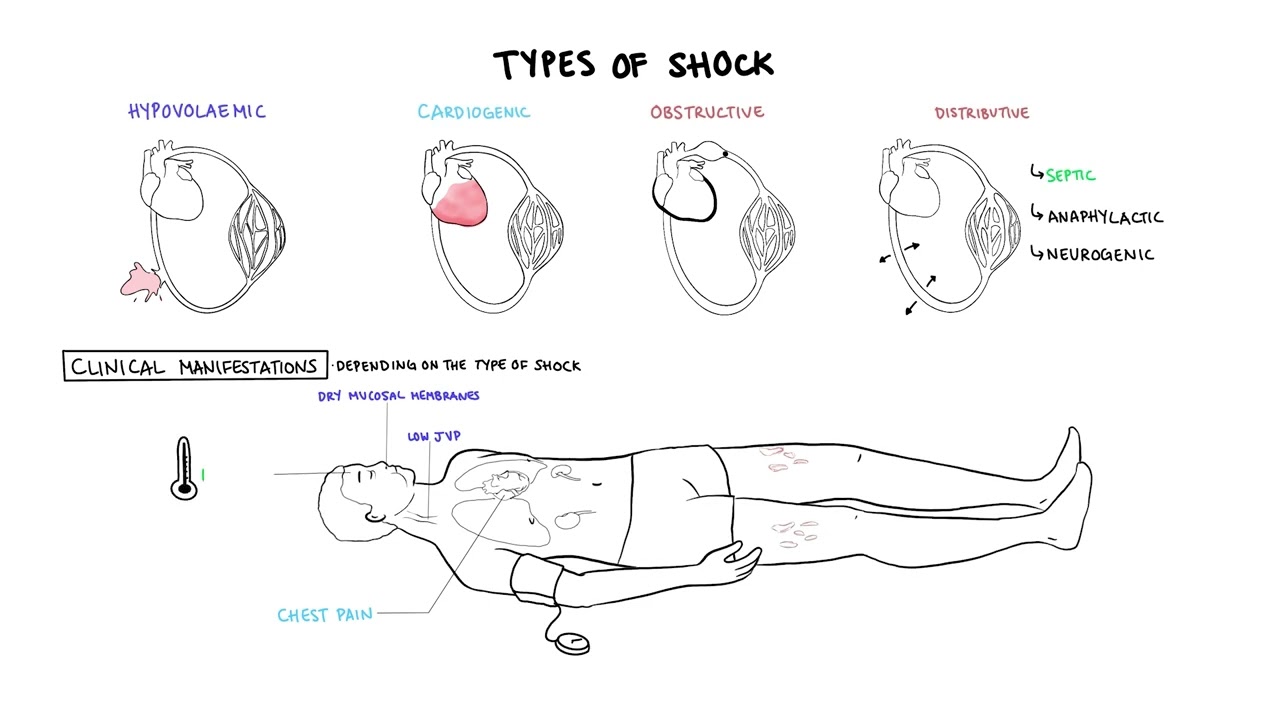 Approach to Shock - types, hypovolemic, cardiogenic, distributive, anaphylaxis, pathology, treatment - YouTube