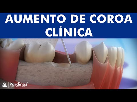 Aumento de coroa clínica ©