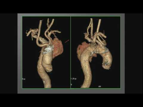 Tętniaki piersiowe, piersiowo-brzuszne aorty w dobie rozwoju technik wewnątrznaczyniowych