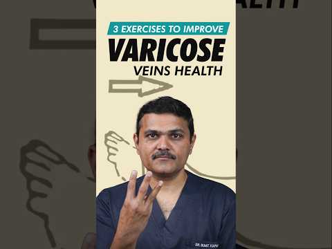 Varicose Vein EXPERT Shares Top 3 Exercises for Relief