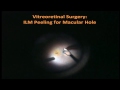Vitroeretinal Surgery