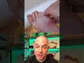 Dermatologist reacts to big infected splinter removal! #dermreacts #doctorreacts #splinter