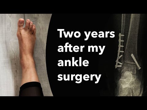Two years after my ankle surgery | Trimalleolar ankle fracture