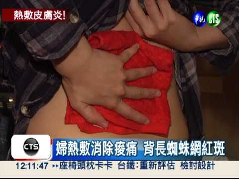 熱敷冒蜘蛛網紅斑 延誤恐致癌