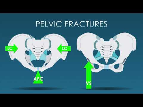 Pelvic trauma Imaging