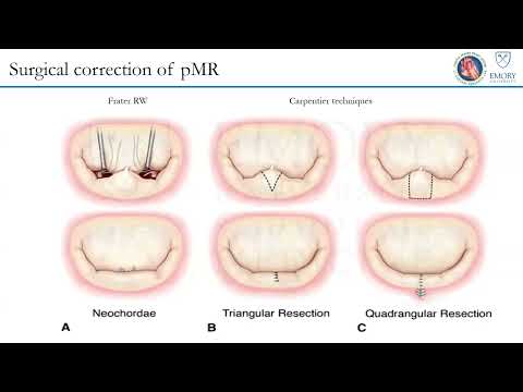 New Approaches to Treating Mitral Regurgitation