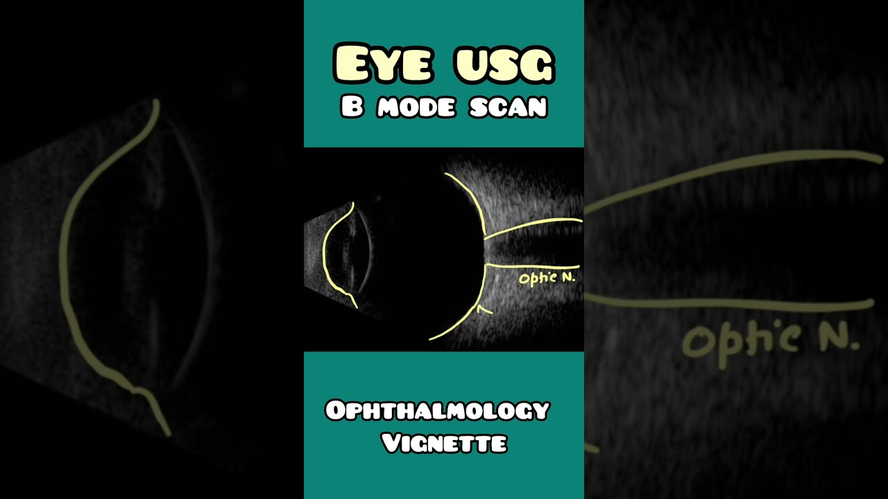 USG of EYE : B mode scan explained simply for USMLE, NEET PG, NCLEX #neet #usmle #biology