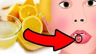 Natural Cures for Mucocele (Mucous Cyst) - How I treat it