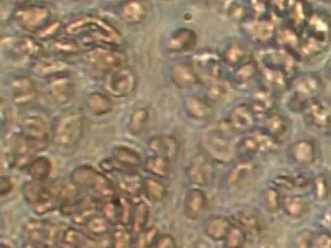 Adhäsionen nach Entfernung der Prostata-Adenom Prostatitis Schmerz in der Seite