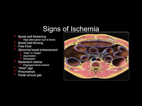 CT evaluation of small bowel obstruction