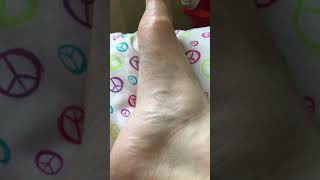 BFS Right foot twitching