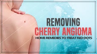 Red Dots on the Skin - Removing Cherry Angioma in 4 Easy Home Remedy