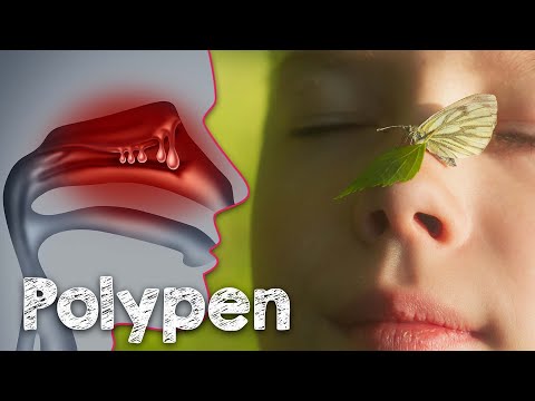 Nasal polyps - adenoid growths - How to prevent them naturally!