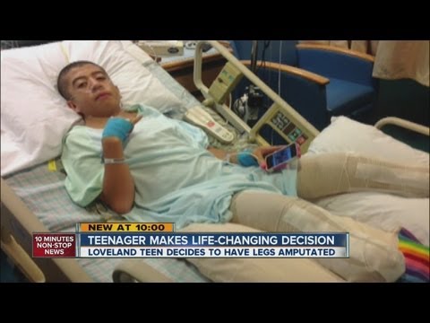 Loveland teen makes painful choice to have legs amputated
