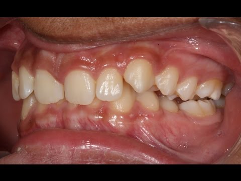 One year orthodontic treatment of class II div 2 with deep bite & unilateral scissor bite