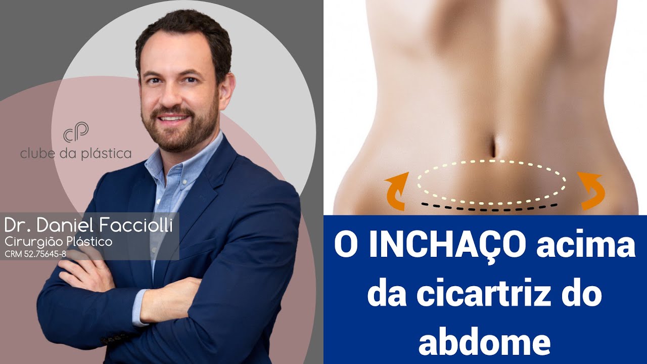 Clube da Plástica: O inchaço acima da cicatriz do abdome