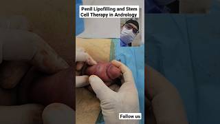 Download lagu Penile Lipofilling and Stem cell therapy in Andrology Dr Araz Bayramov #penis penilenlargement.com mp3 Download lagu Penile Lipofilling and Stem cell therapy in Andrology Dr Araz Bayramov #penis penilenlargement.com mp3