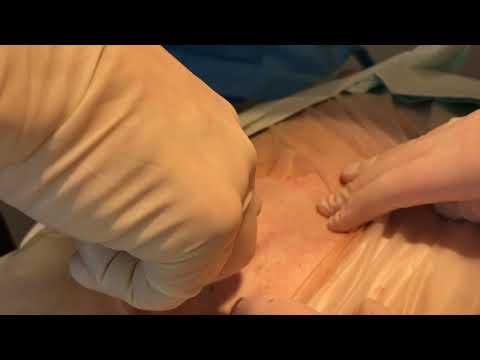 Bőr alatti helminták kezelése - Paraziták elleni vedekezes