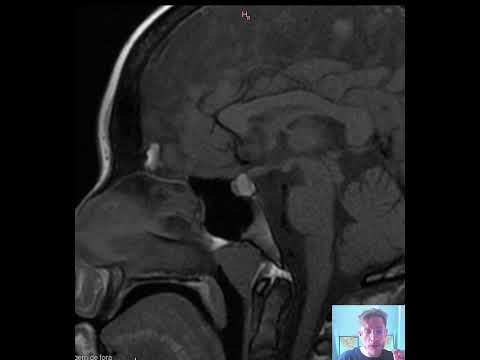 Cisto remanescente da fenda de Rahtke