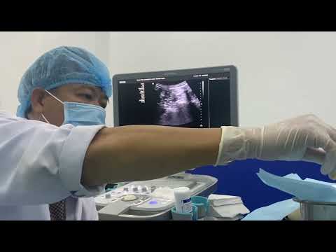 TLIP Block for Post Epidural Steroids Injection Flare Up Pain