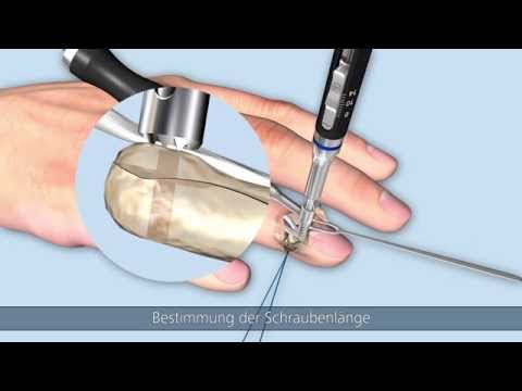 Linos – Strecksehnenabriss am Endglied