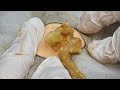 Enjoying with popping large squeeze acne in young patient explosive inflammation 1705 153350