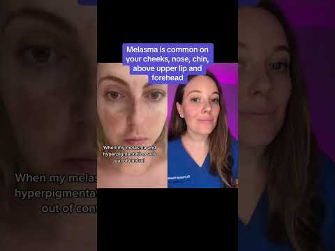 Treating Melasma Dark Spots