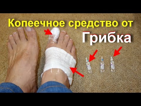 Ob man gribok der Nägel auf den Beinen vom Pech heilen kann Die Schuhe bei der Behandlung gribka der Nägel zu bearbeiten