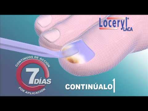 El tratamiento la partida de las uñas Los consejos del tratamiento del hongo de los pie