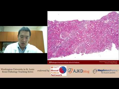 Web Episode #010 - Renal Pathology Teaching Series, Introducing Lupus Nephritis