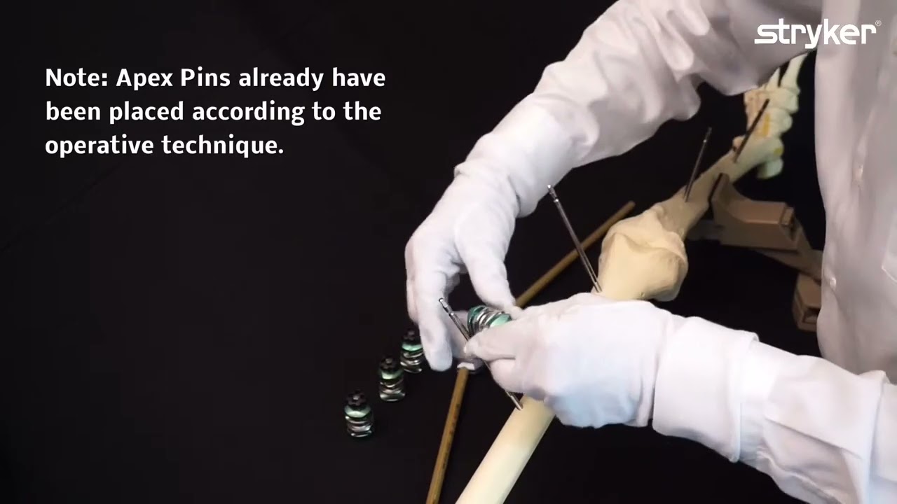 Hoffmann 3 External Fixation System: How to build a Knee Bridging Frame with the rod coupler.