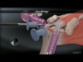 Réparation de la coiffe des rotateurs de l'épaule sous arthroscopie