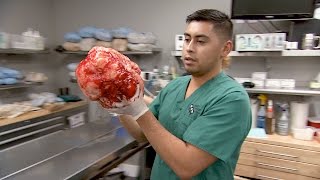 See The Whole Procedure That Led To The Removal Of A Massive Tumor From This Doberman