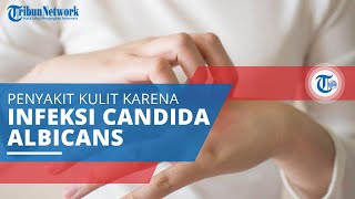 Kandidiasis, Penyakit Kulit akibat Jamur Candida Albicans dan Terjadi di Kulit dan Organ Intim
