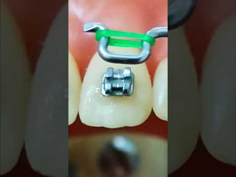 Vídeo: Como colocar borrachinha no aparelho: perguntas e respostas